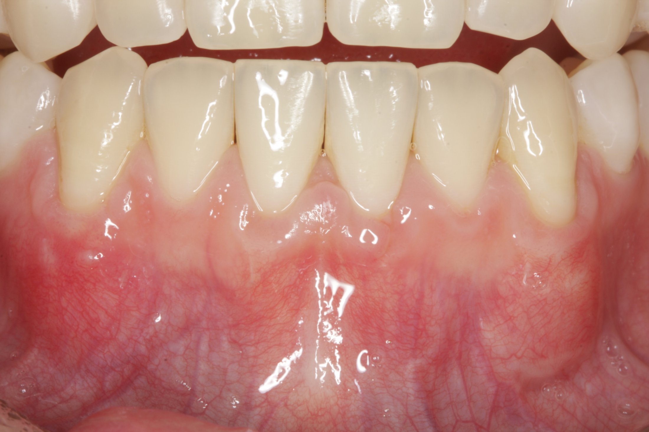 Connective Tissue Graft case study