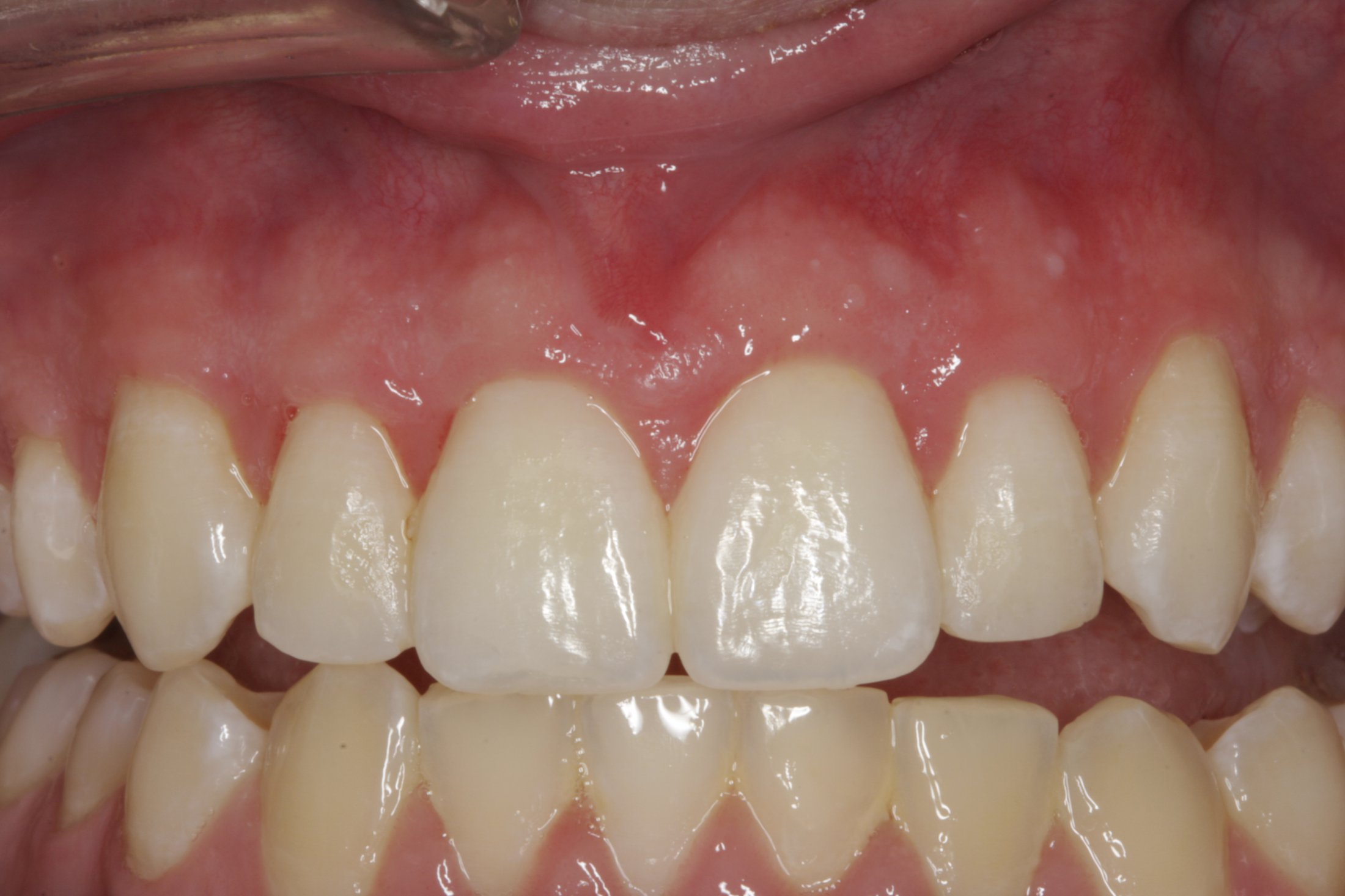 Esthetic Crown Lengthening case study