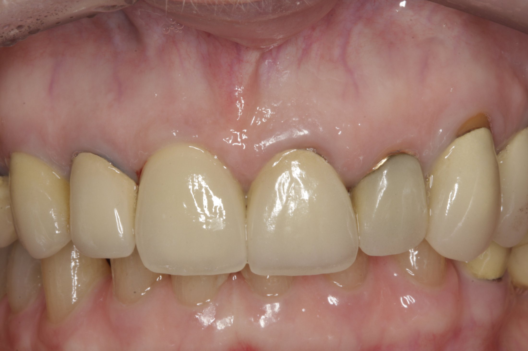 Dental Implants case study