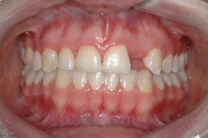 Dental Implants case study