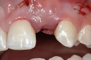 Dental Implants case study