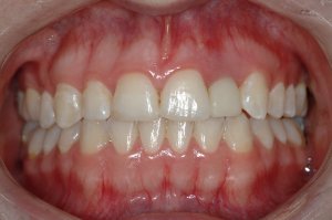Dental Implants case study