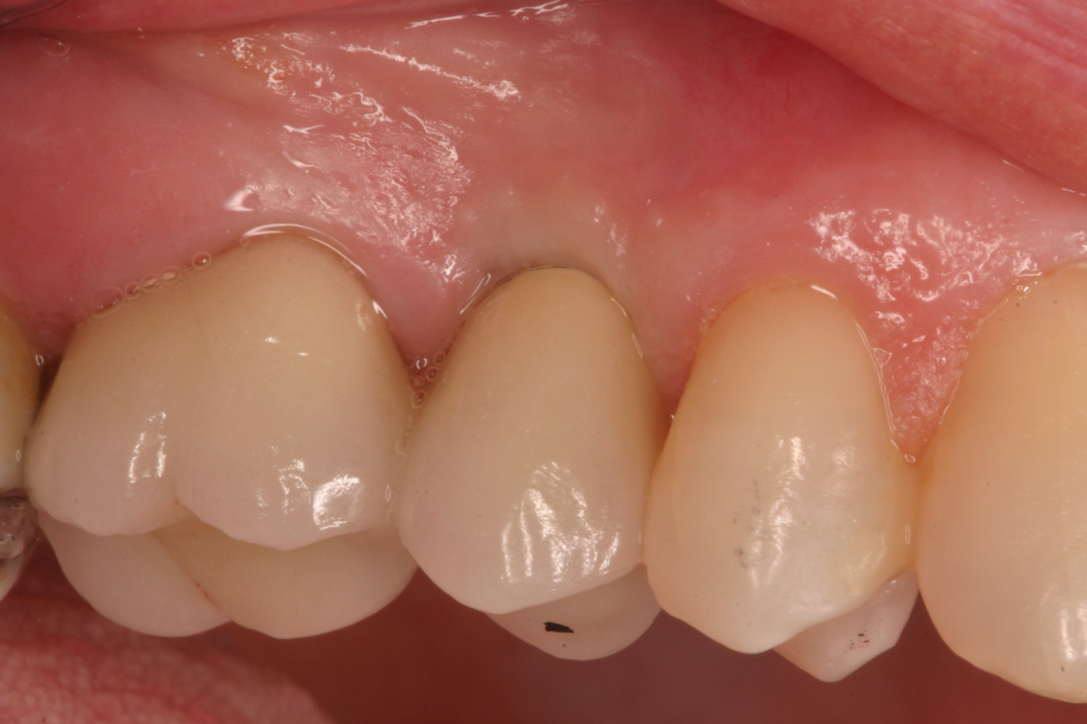 Dental Implants case study