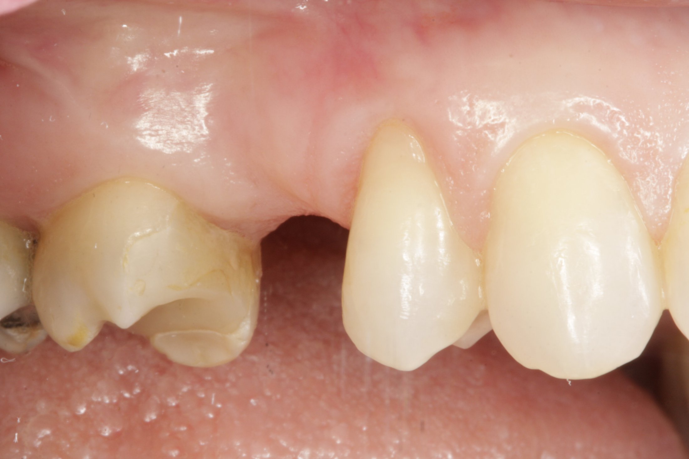 Dental Implants case study