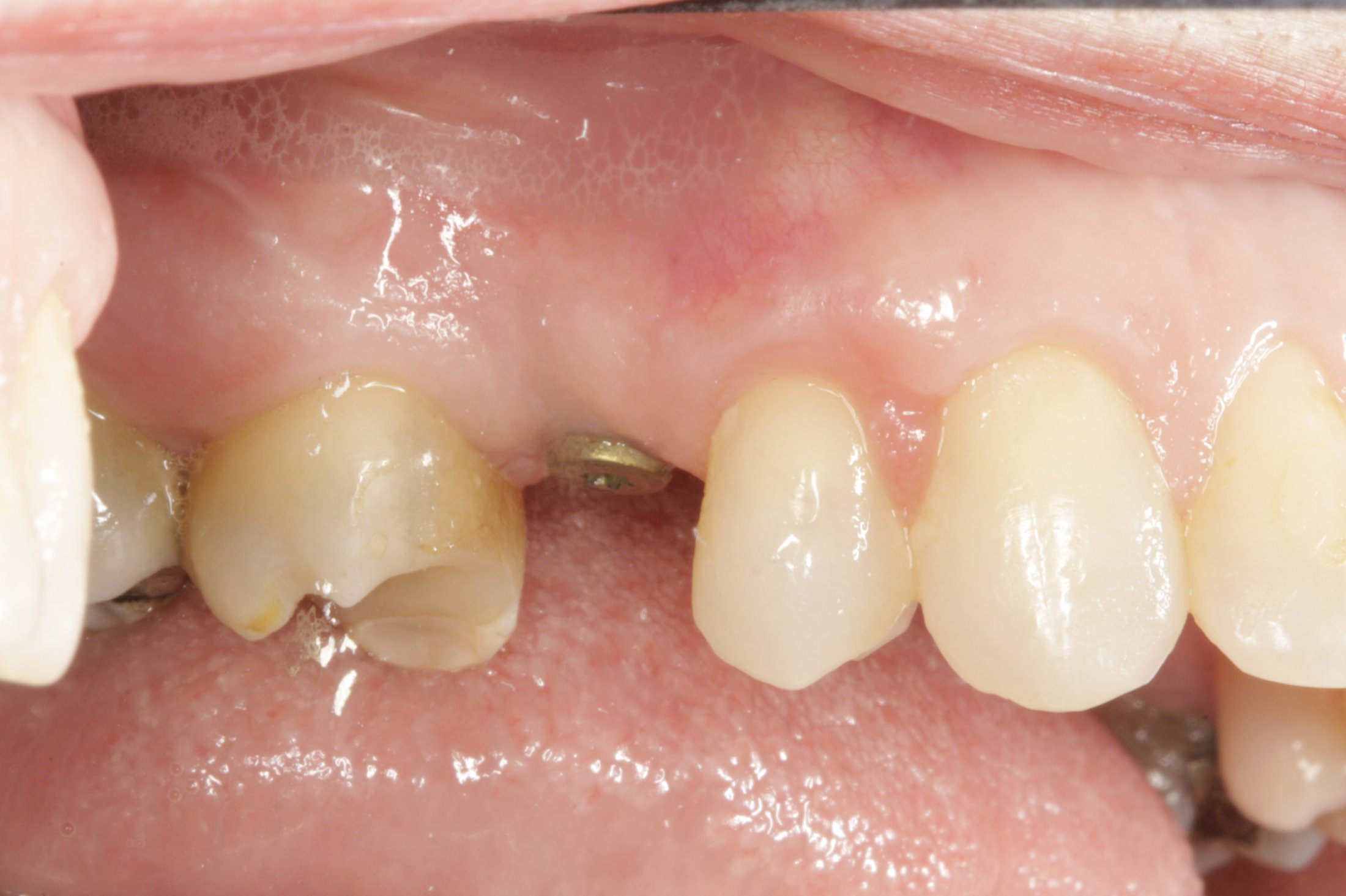 Dental Implants case study