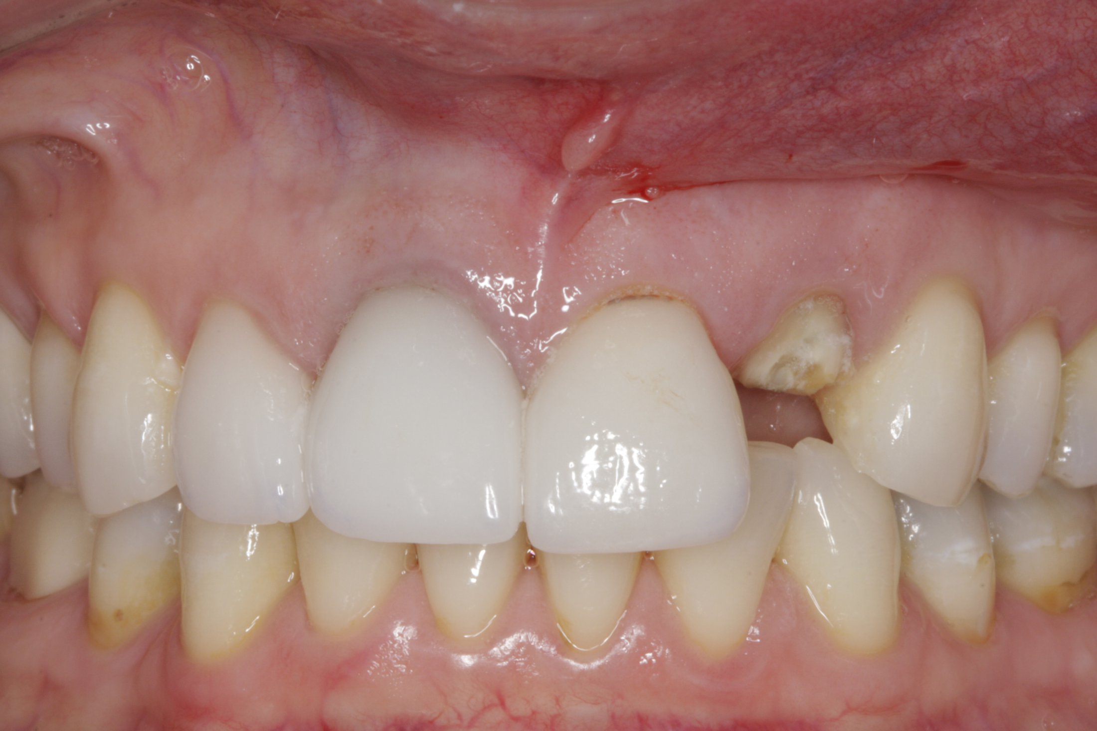 Dental Implants case study