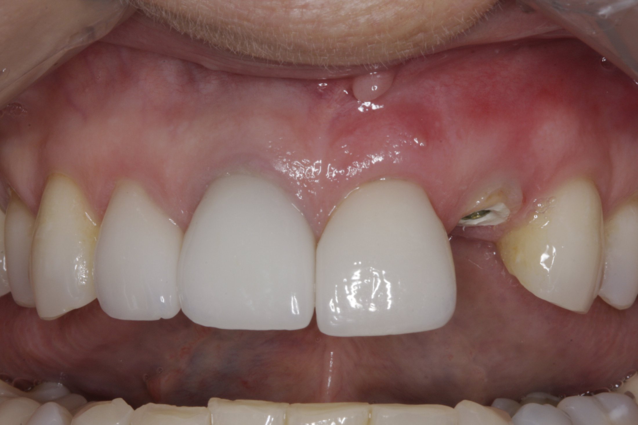 Dental Implants case study