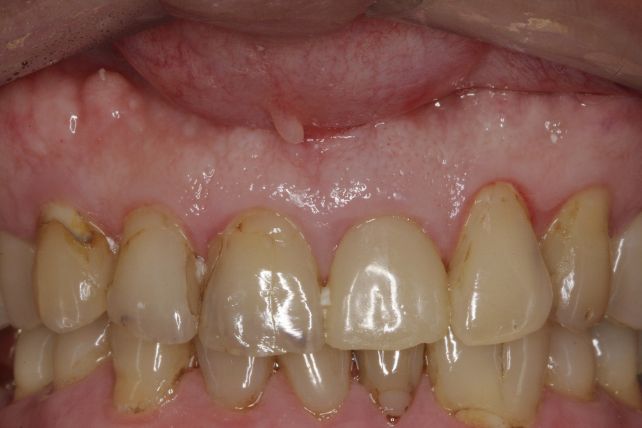 Dental Implants case study