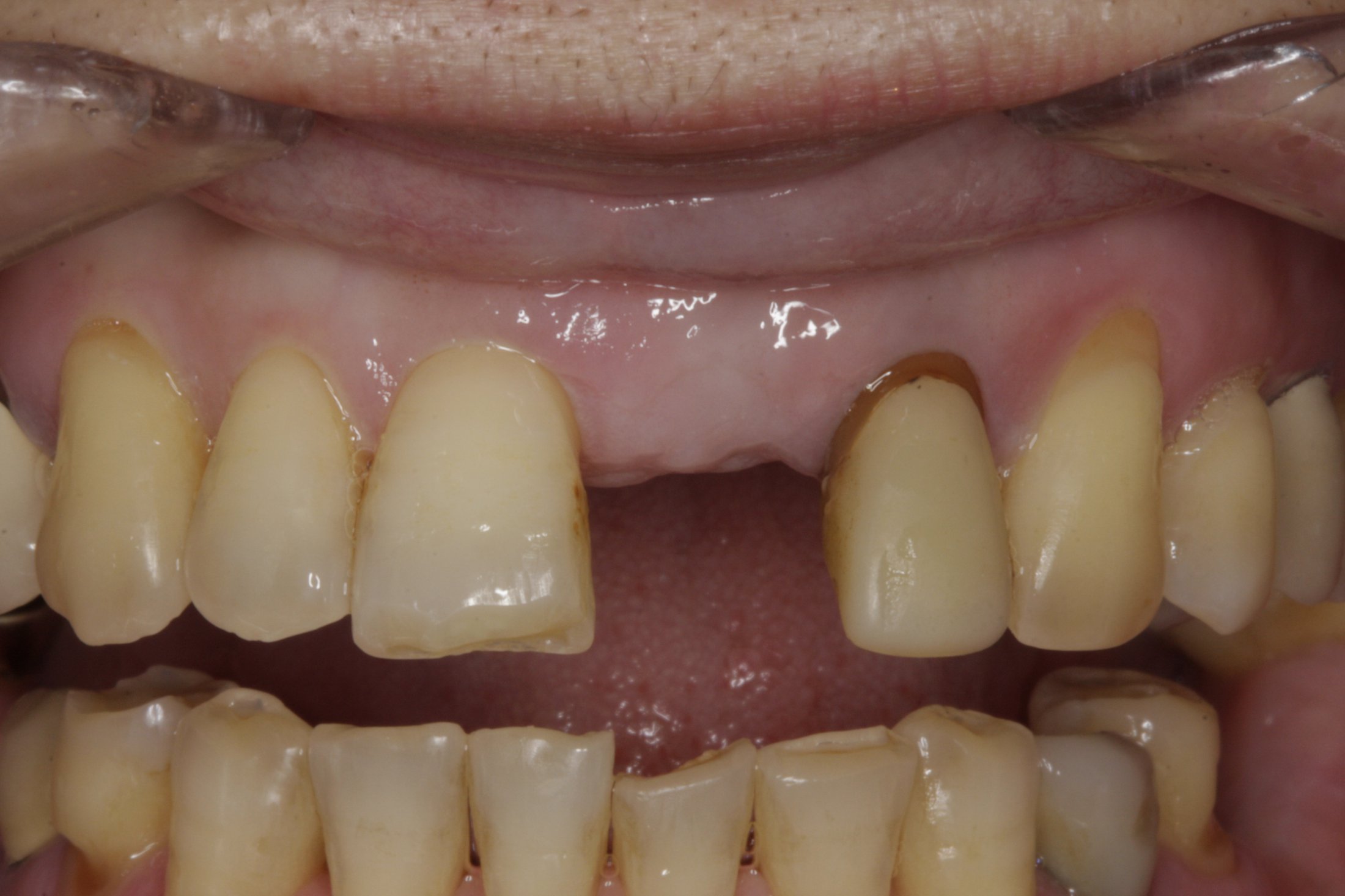 Dental Implants case study