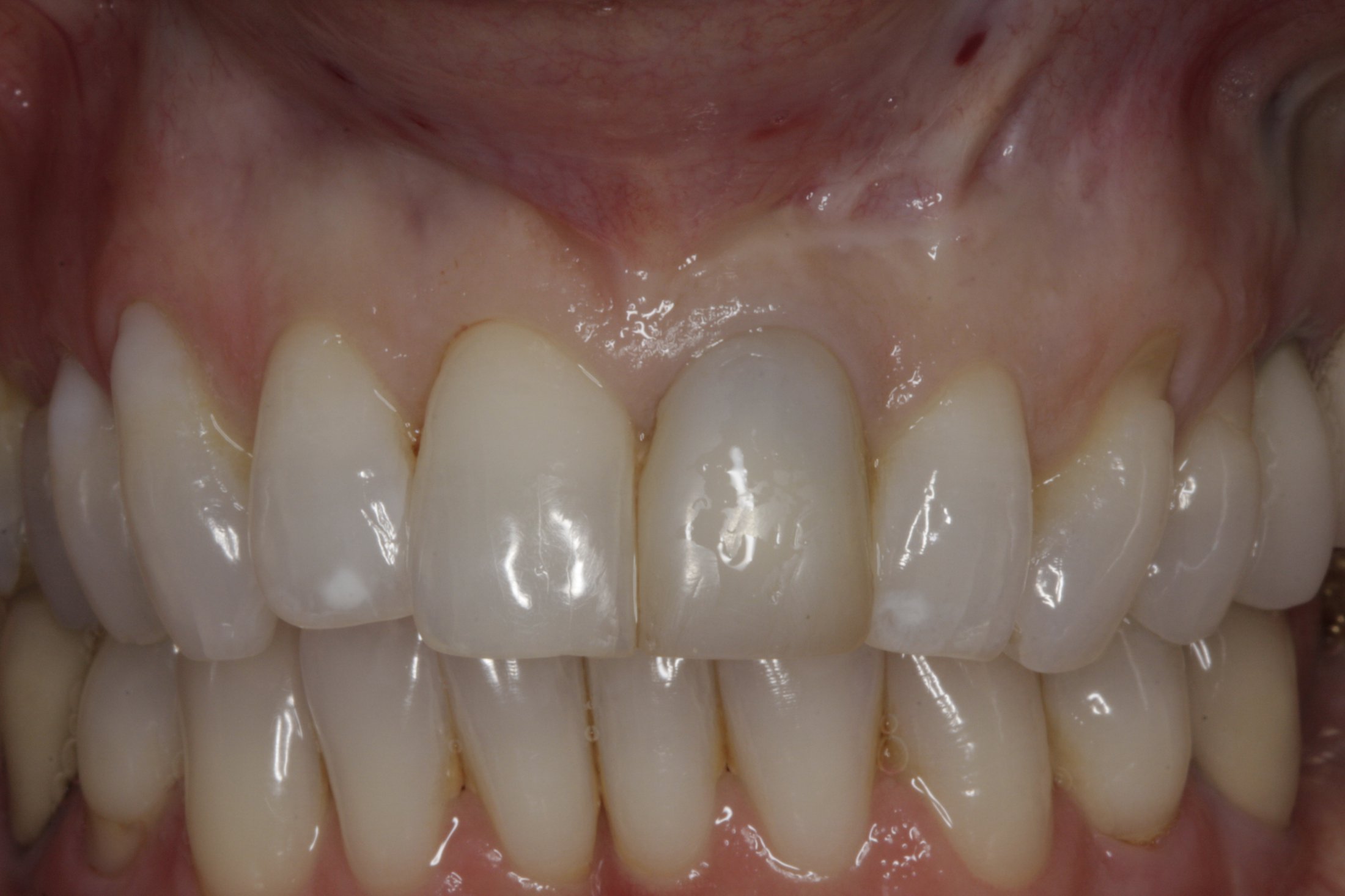 Dental Implants case study
