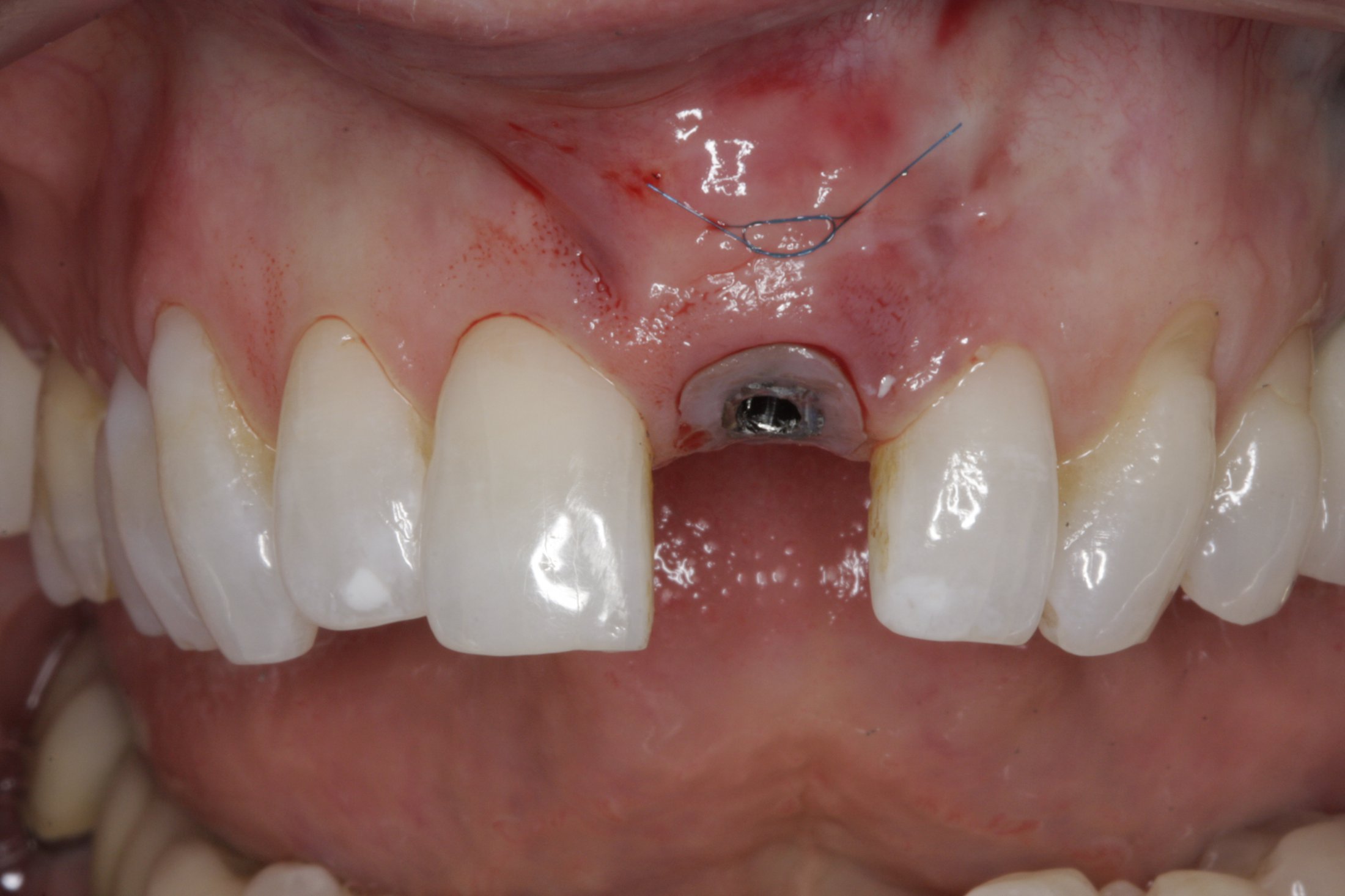 Dental Implants case study