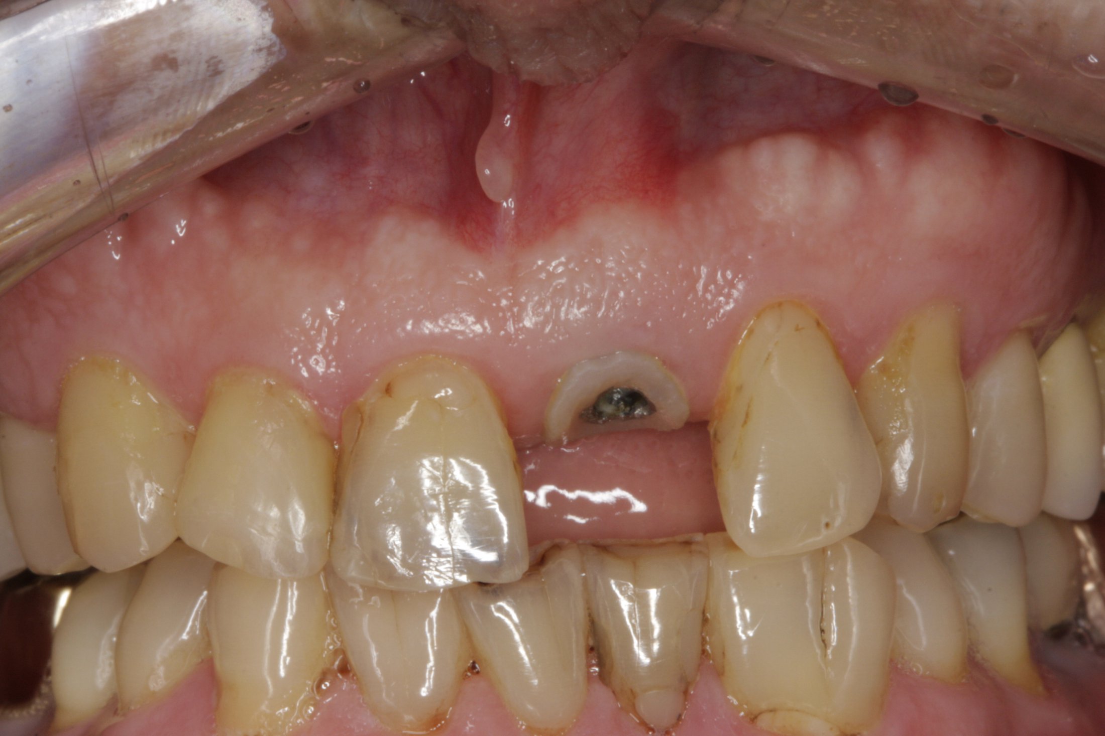 Dental Implants case study