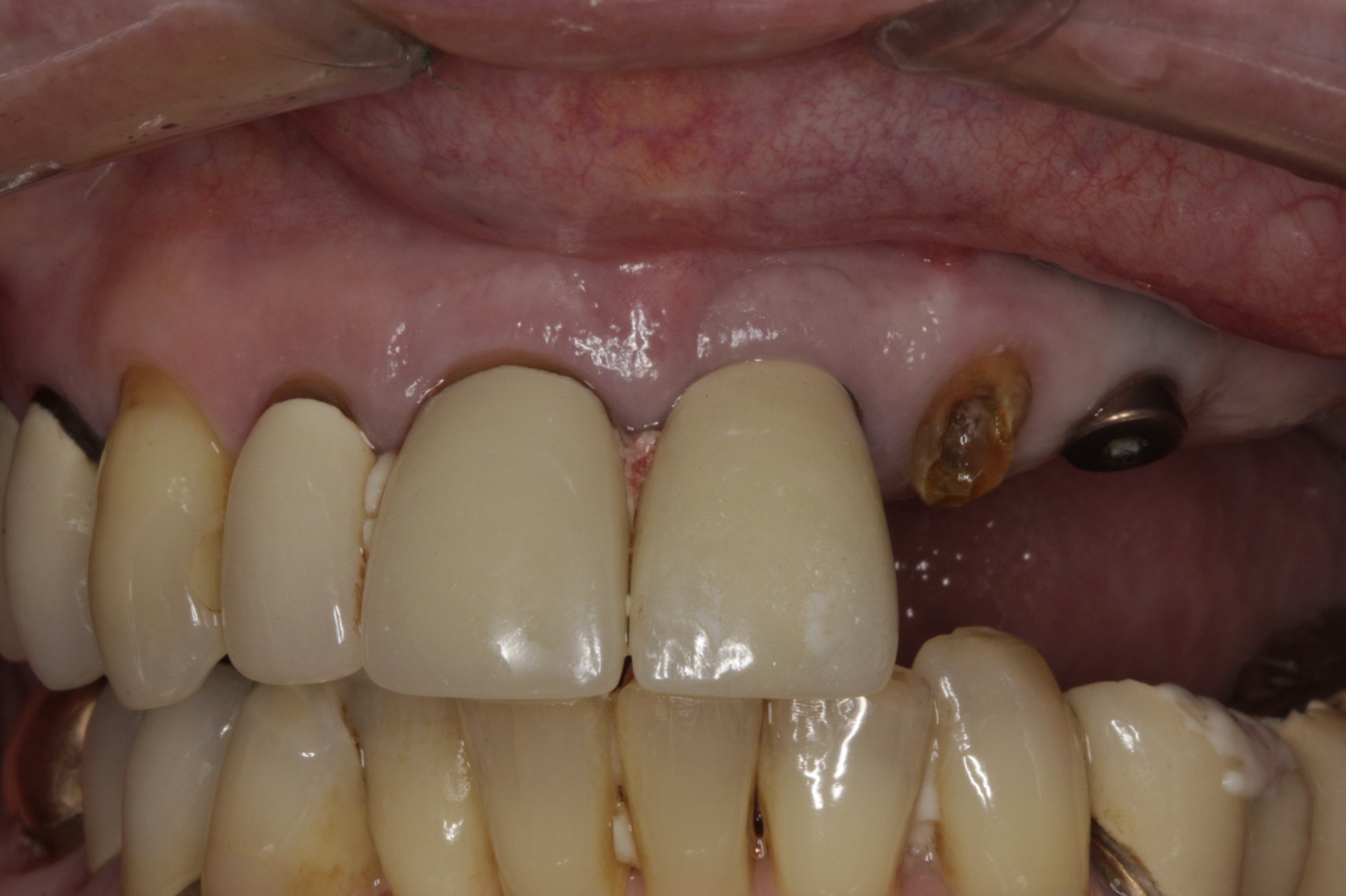 Dental Implants case study