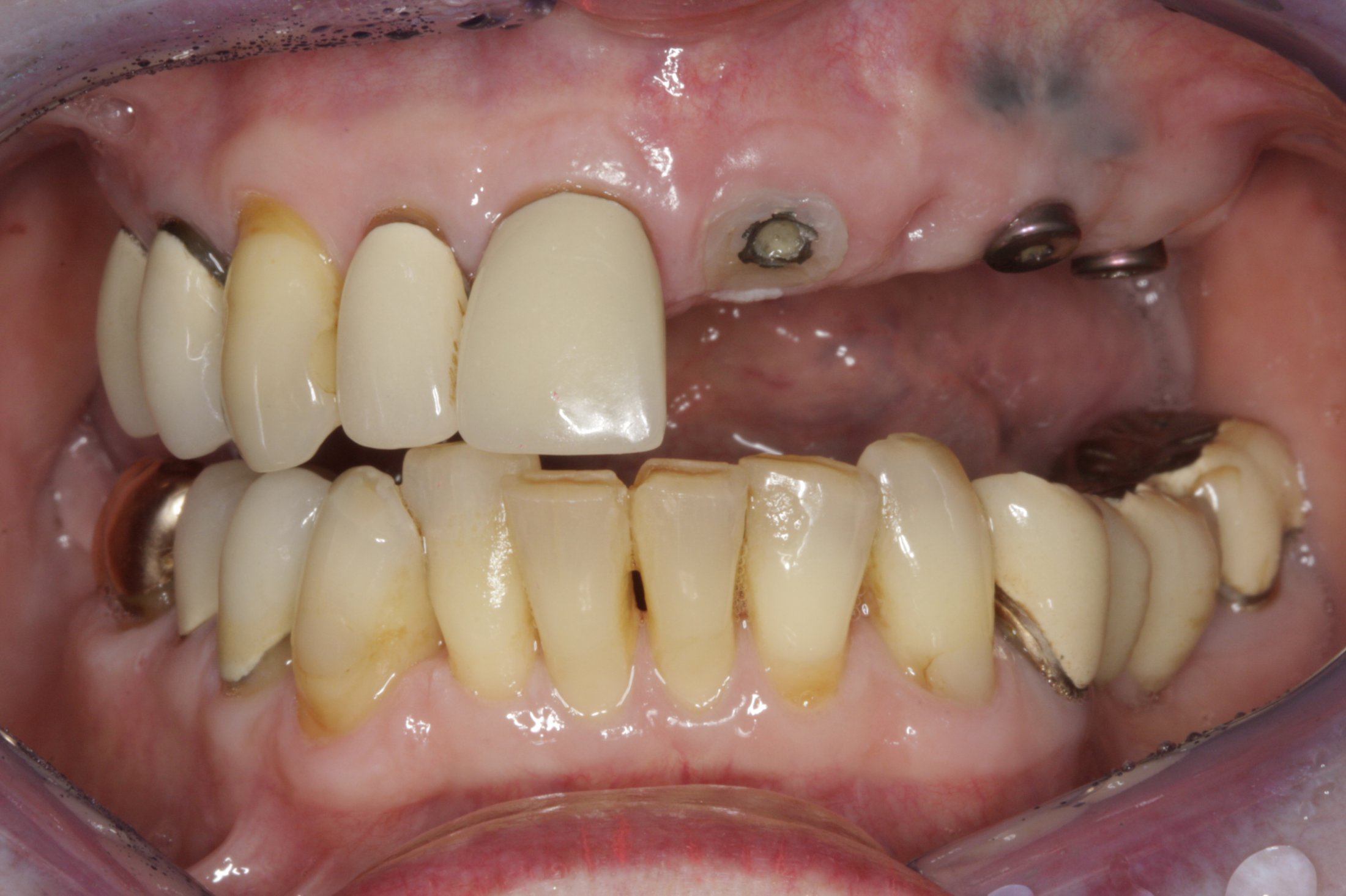 Dental Implants case study