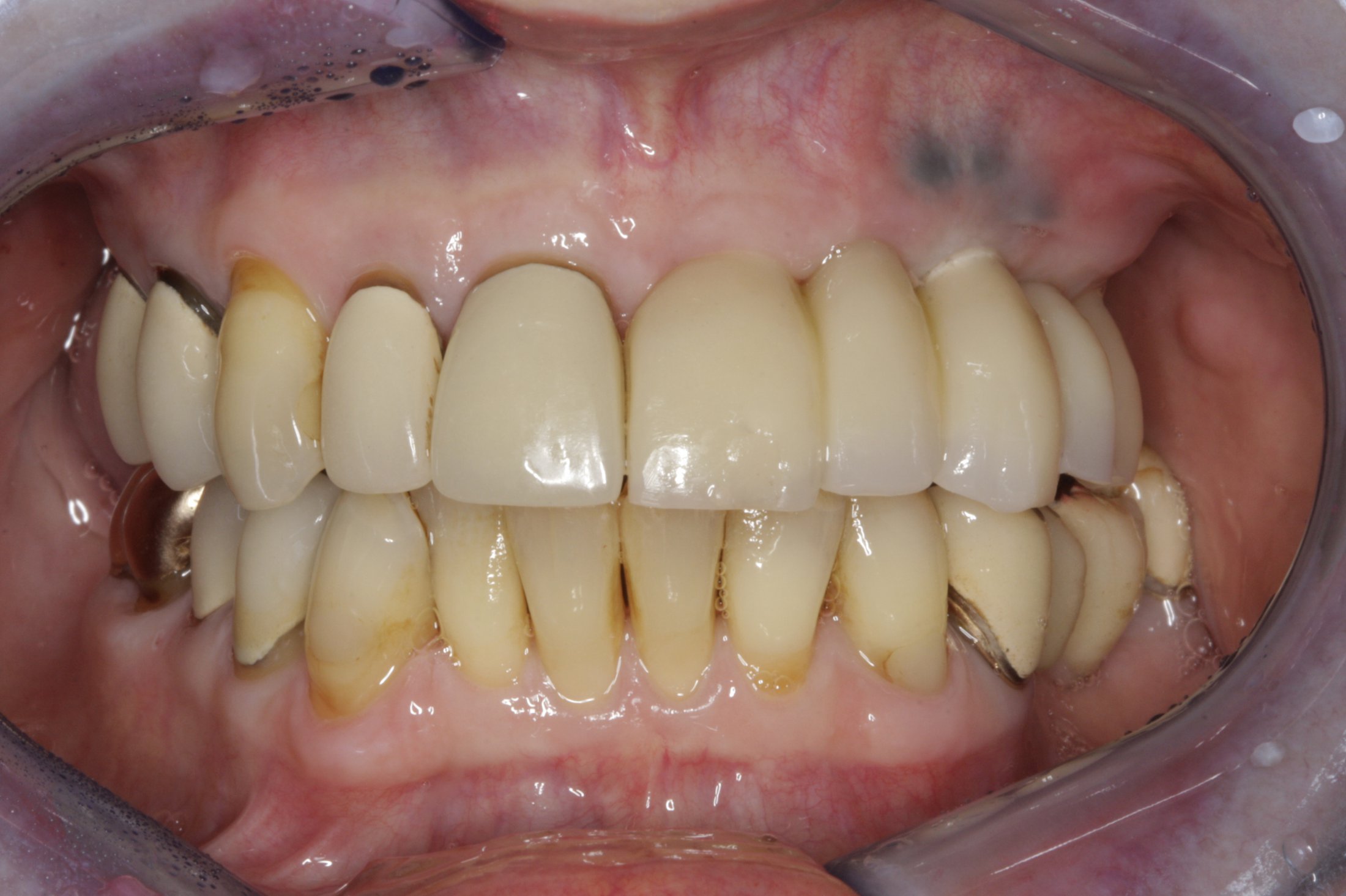 Dental Implants case study