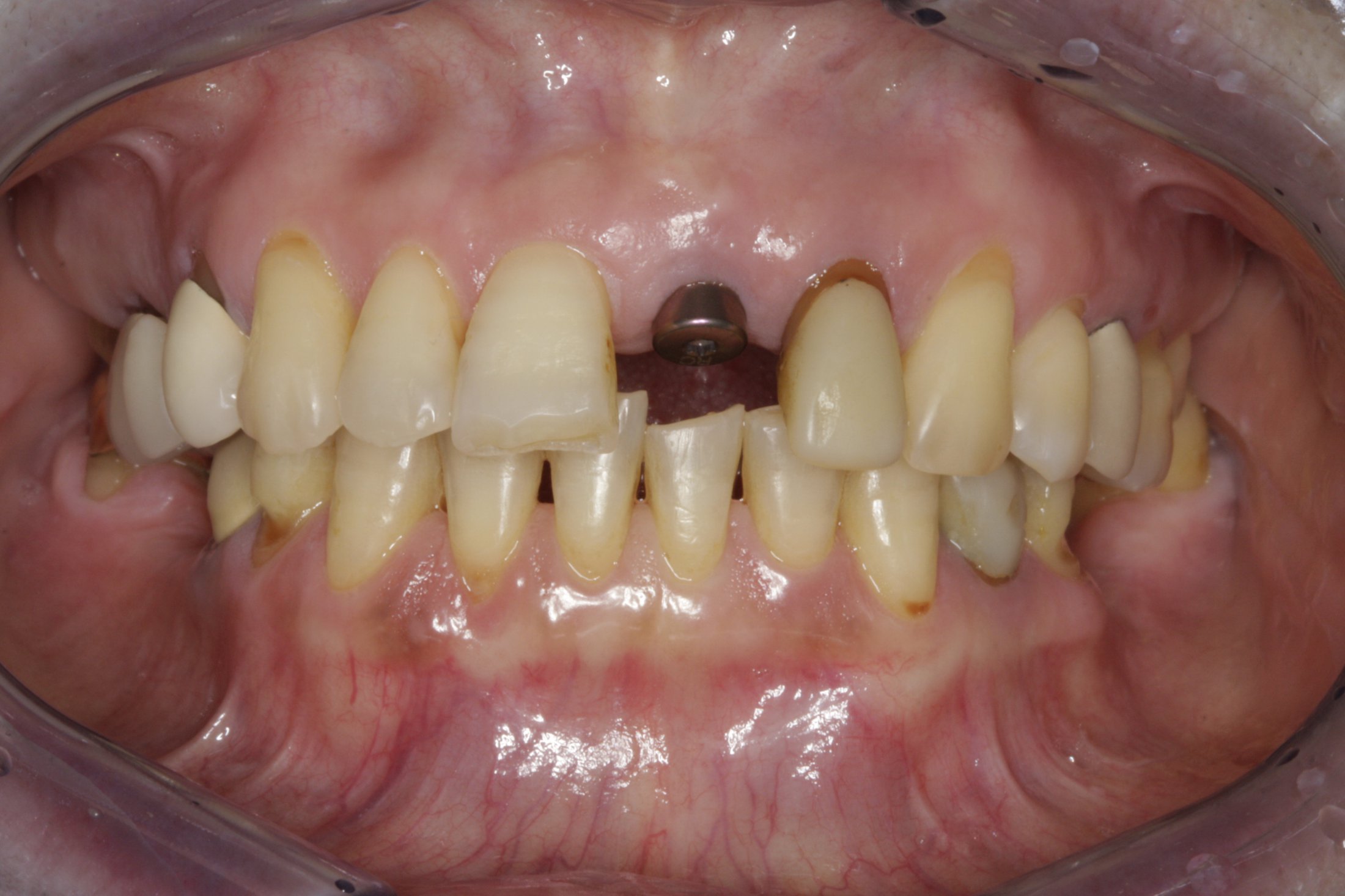 Dental Implants case study