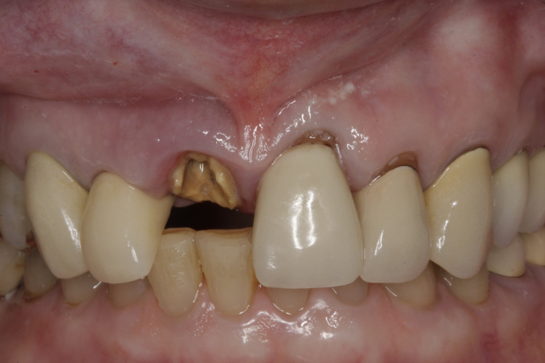 Dental Implants case study