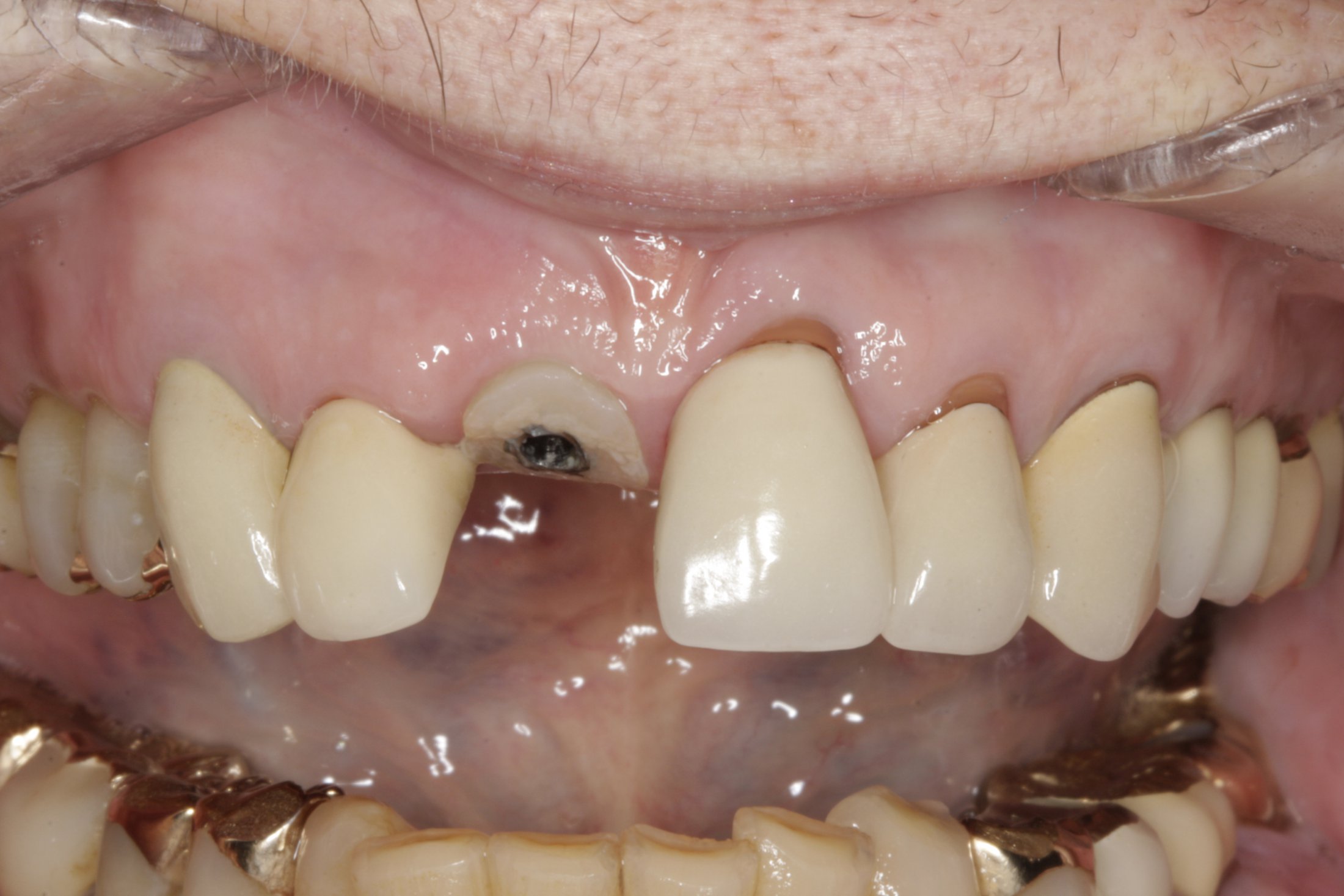 Dental Implants case study
