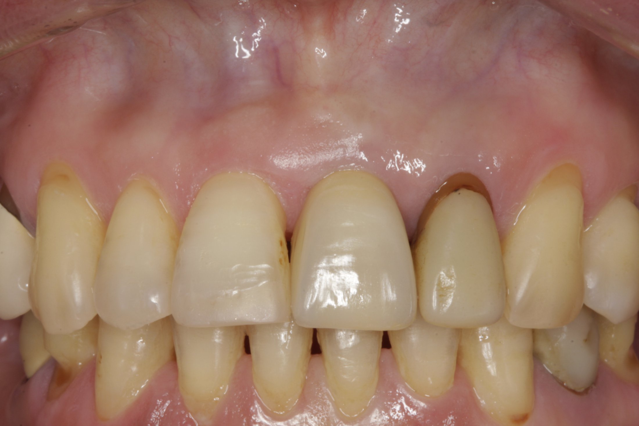 Dental Implants case study