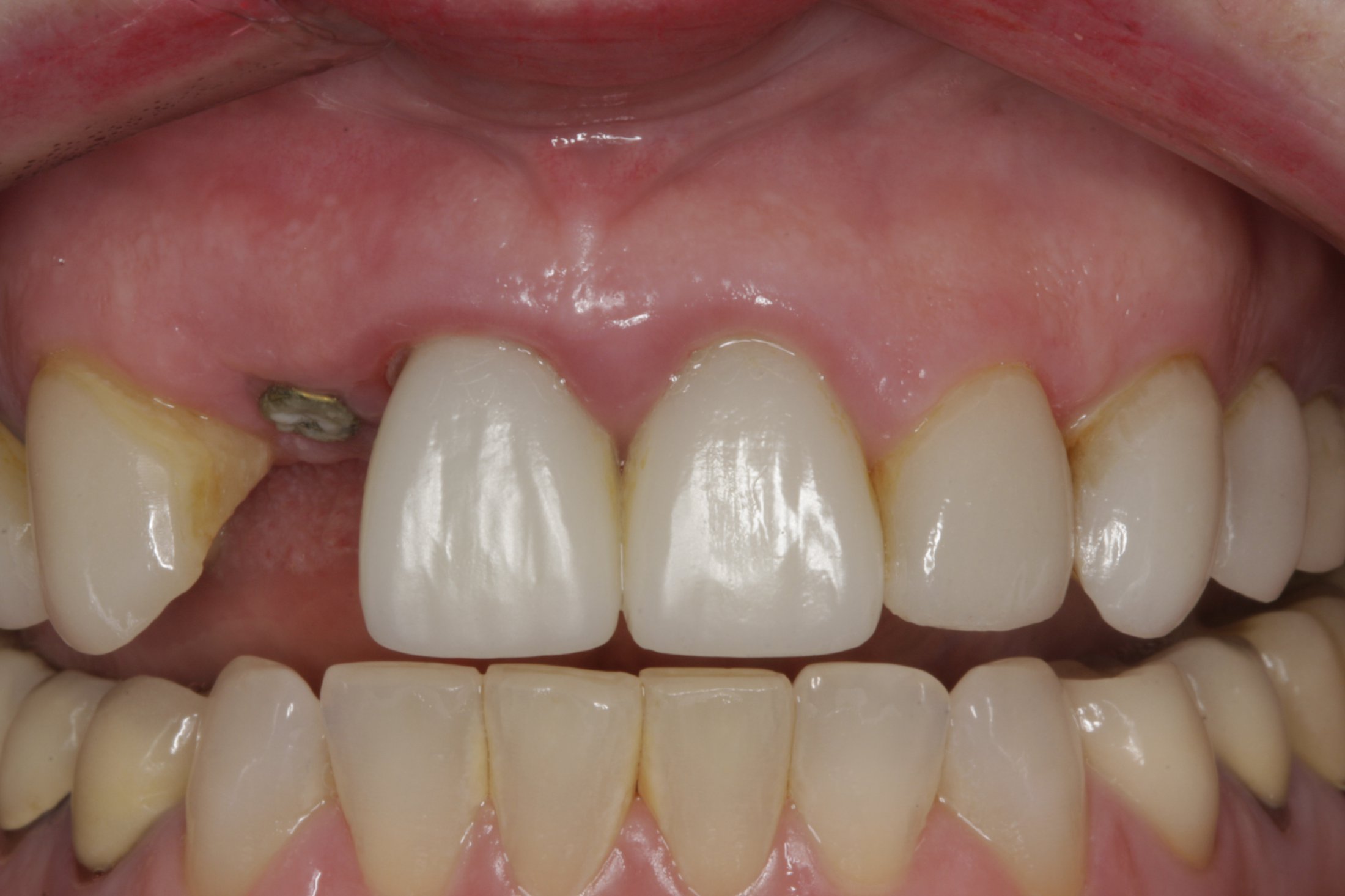 Dental Implants case study