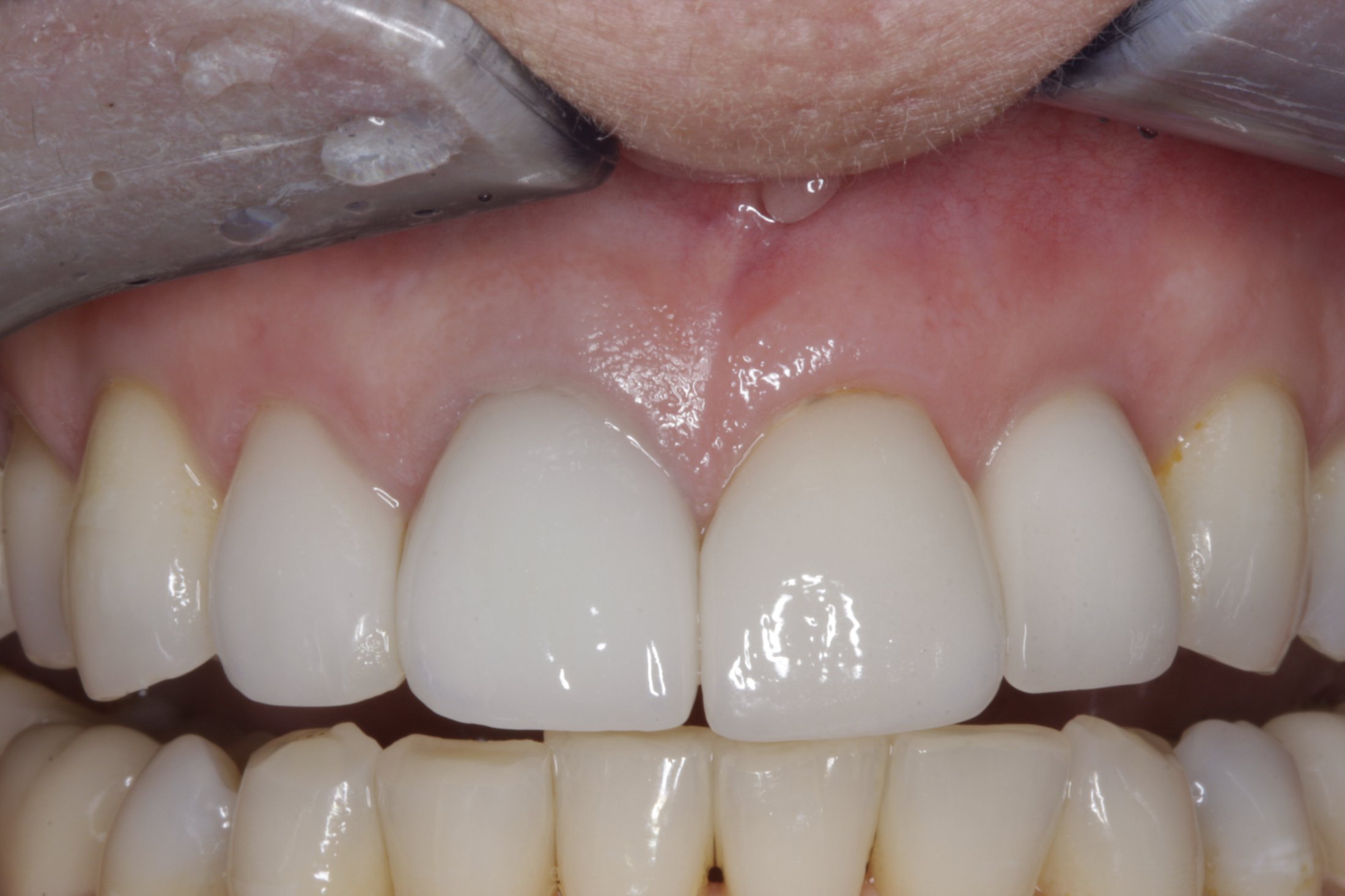 Dental Implants case study