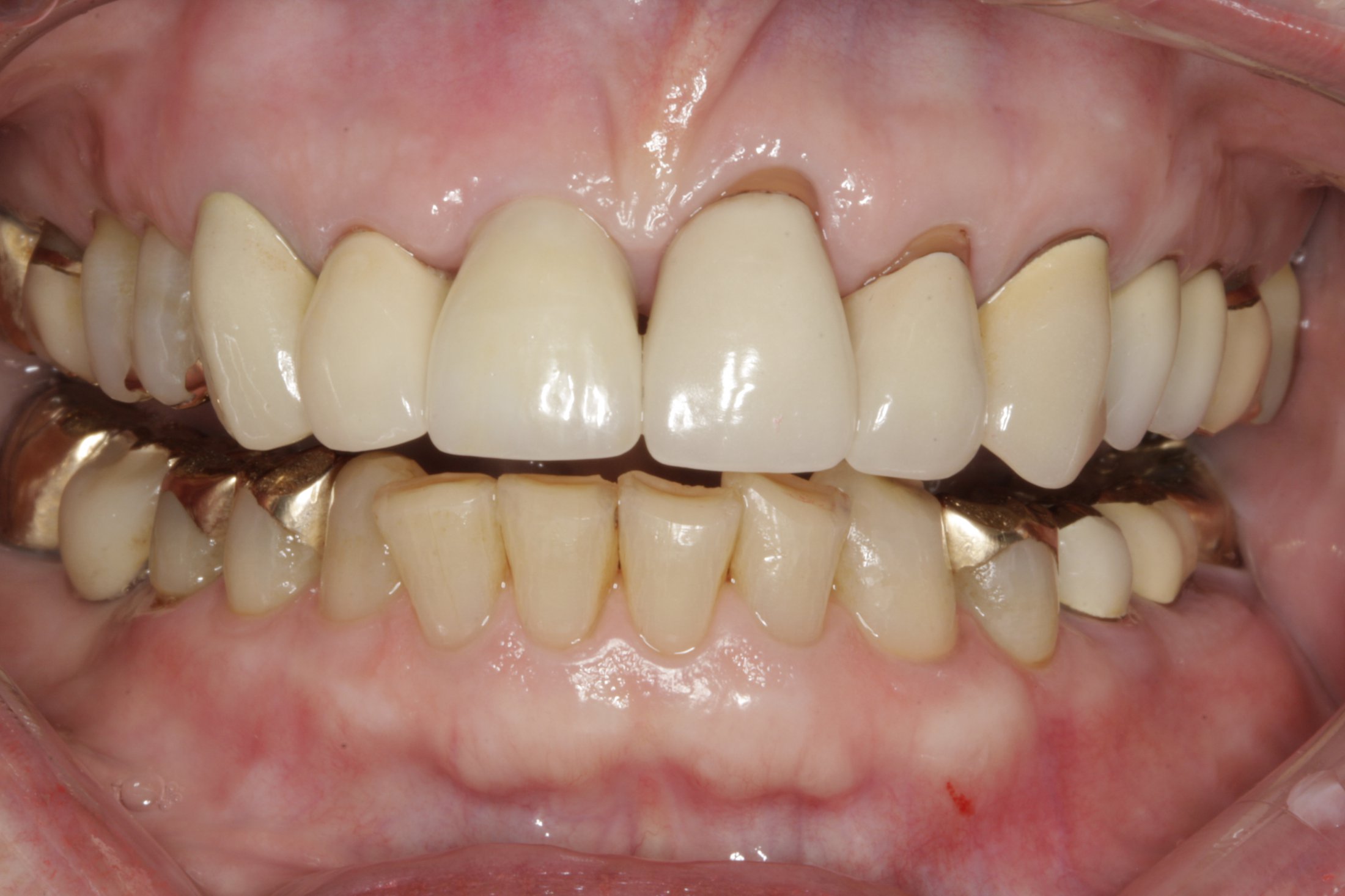 Dental Implants case study