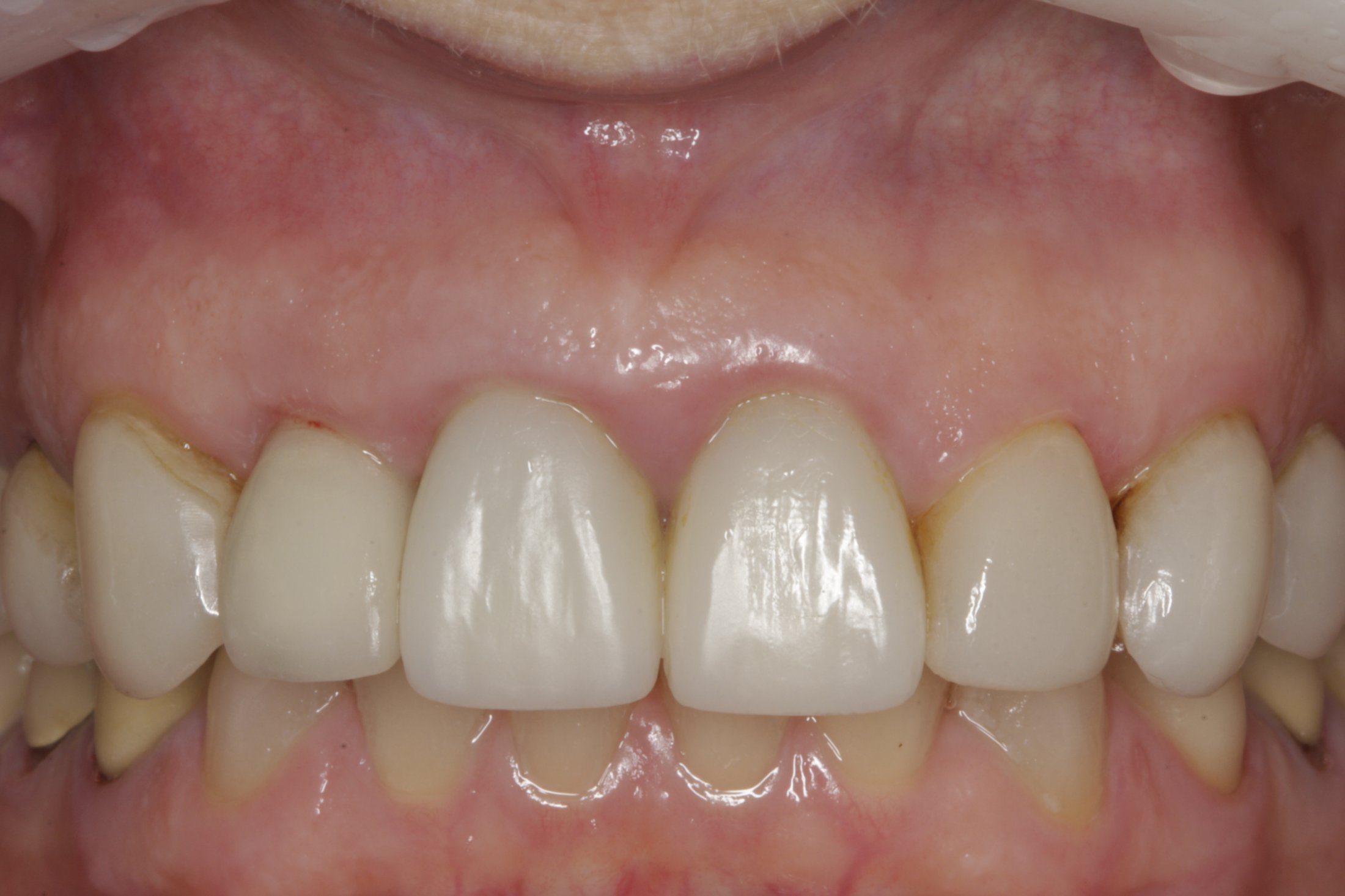 Dental Implants case study