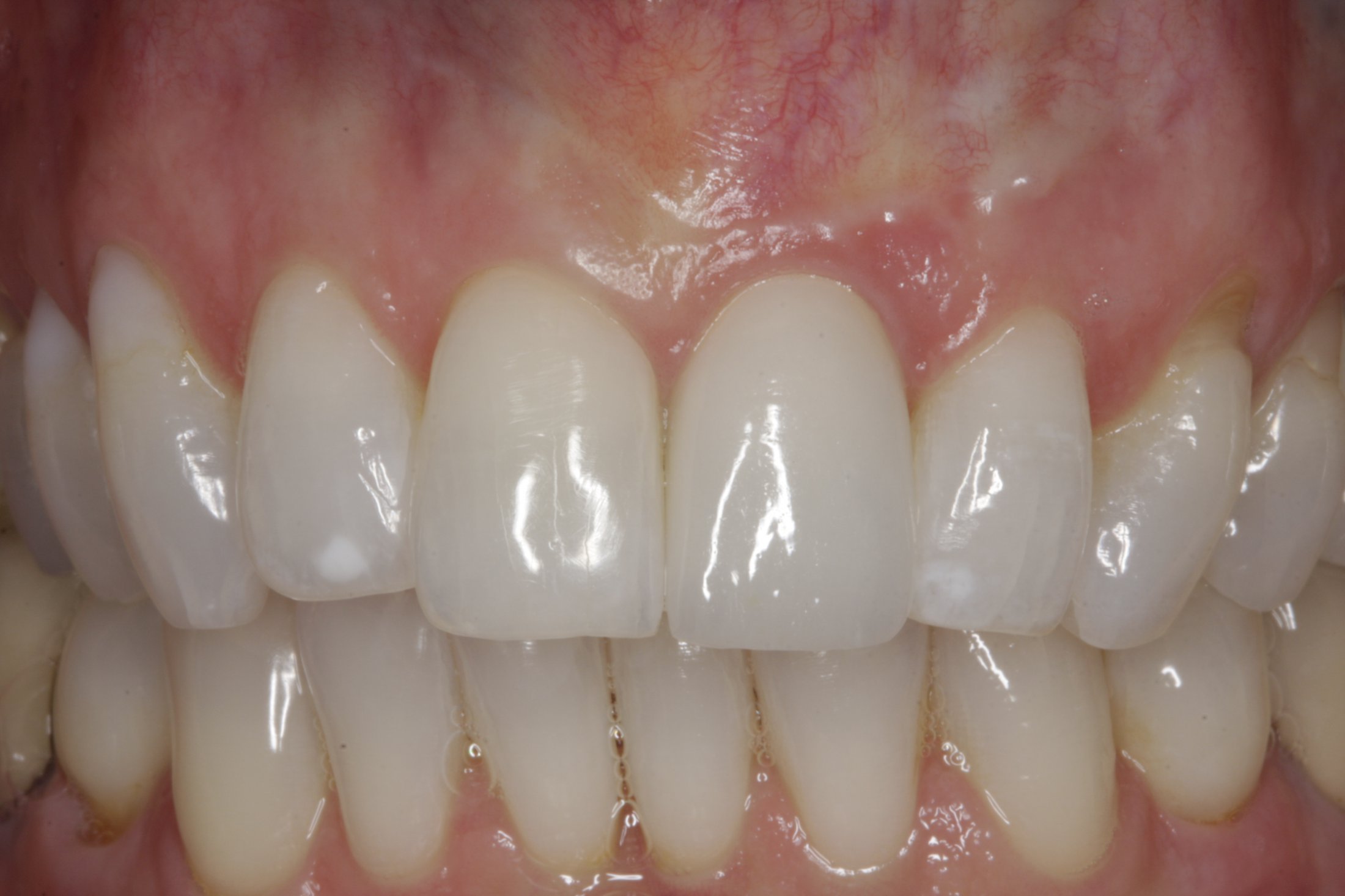 Dental Implants case study