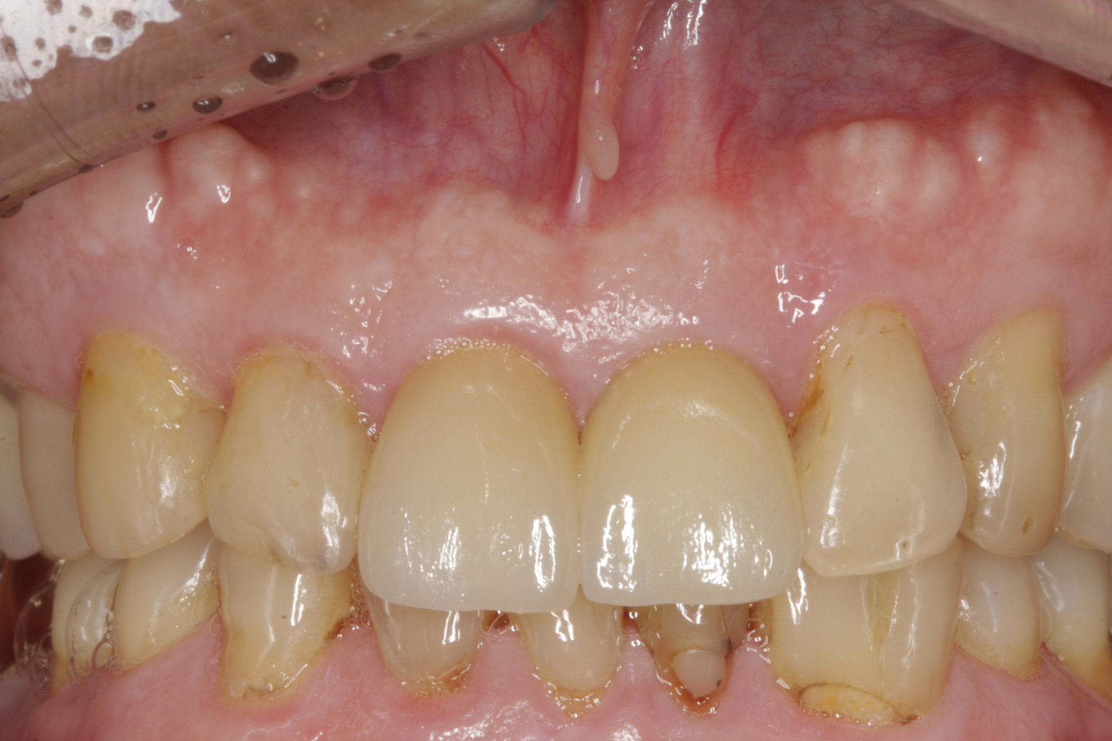 Dental Implants case study