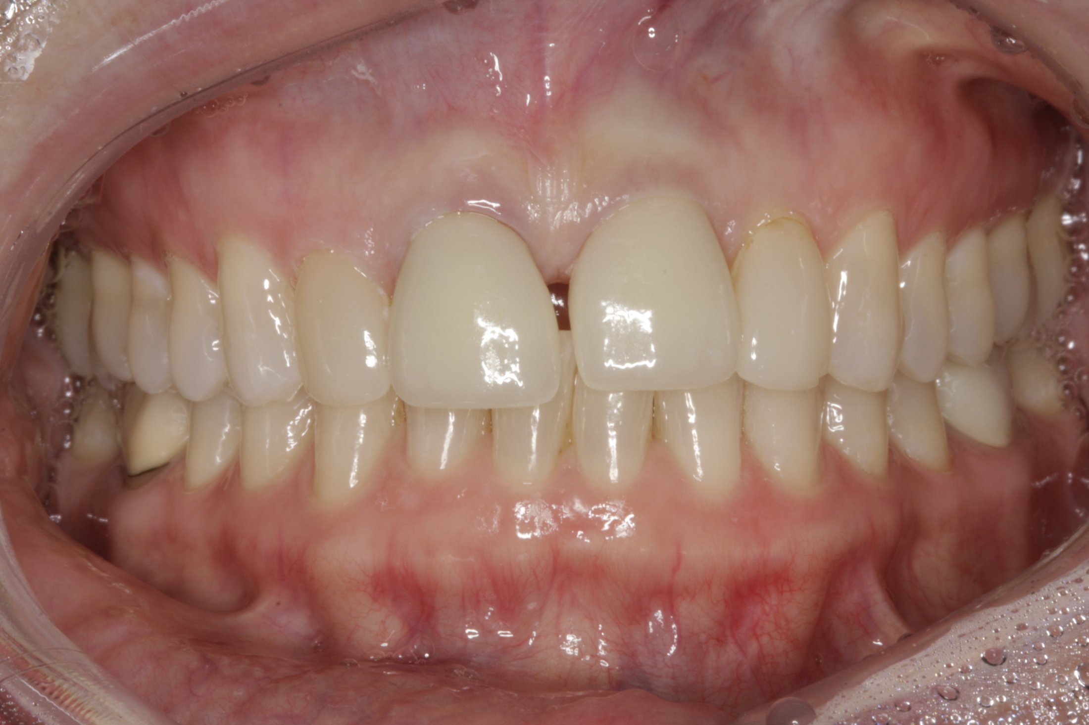 Dental Implants case study