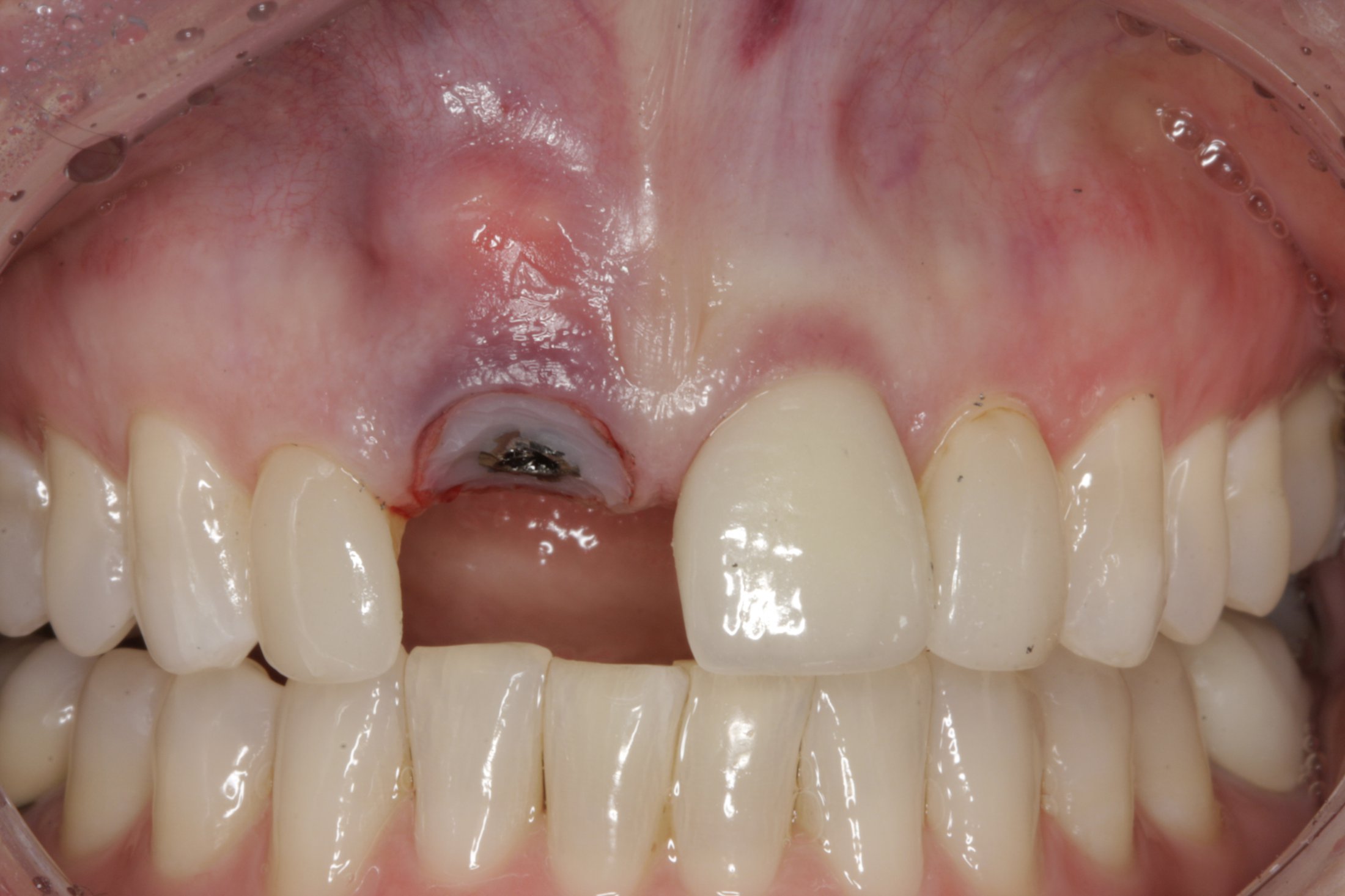 Dental Implants case study