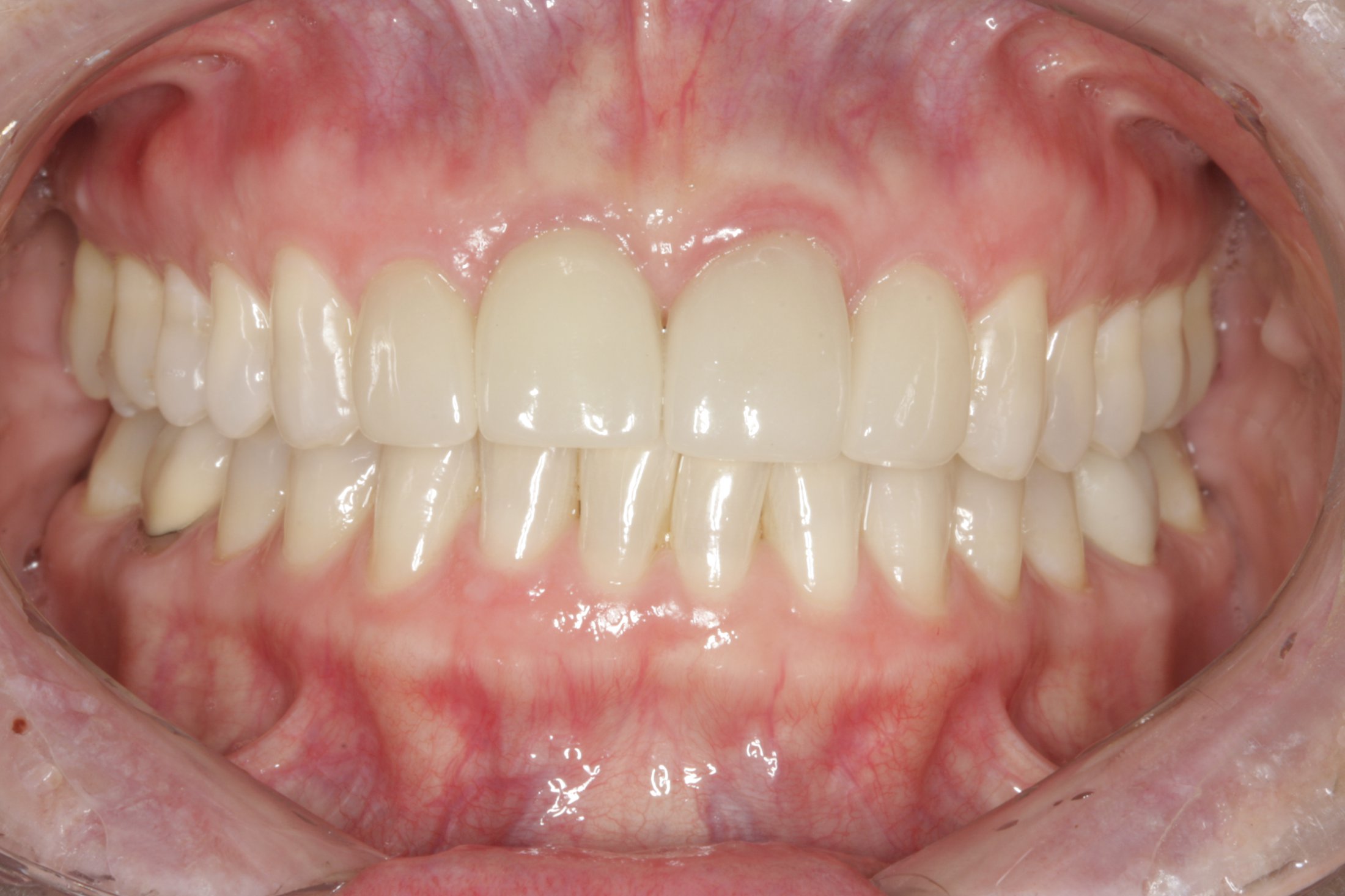 Dental Implants case study