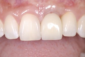 Dental Implants case study