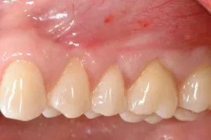 Connective Tissue Graft case study
