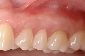 Connective Tissue Graft case study