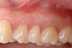 Connective Tissue Graft case study