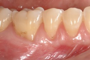 Connective Tissue Graft case study