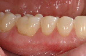 Connective Tissue Graft case study