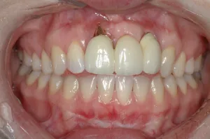 Connective Tissue Graft case study