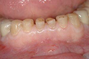 Esthetic Crown Lengthening case study