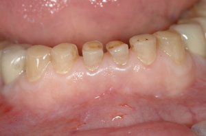 Esthetic Crown Lengthening case study