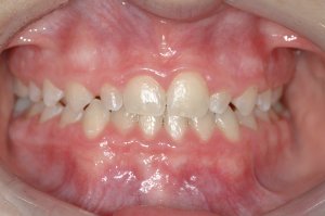 Esthetic Crown Lengthening case study