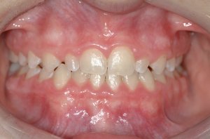 Esthetic Crown Lengthening case study