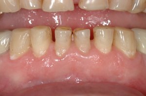 Esthetic Crown Lengthening case study