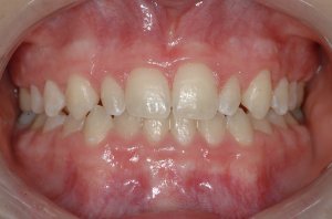 Esthetic Crown Lengthening case study