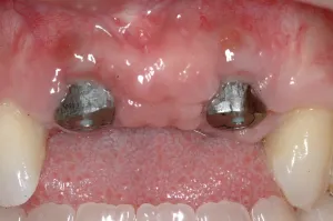 Connective Tissue Graft case study