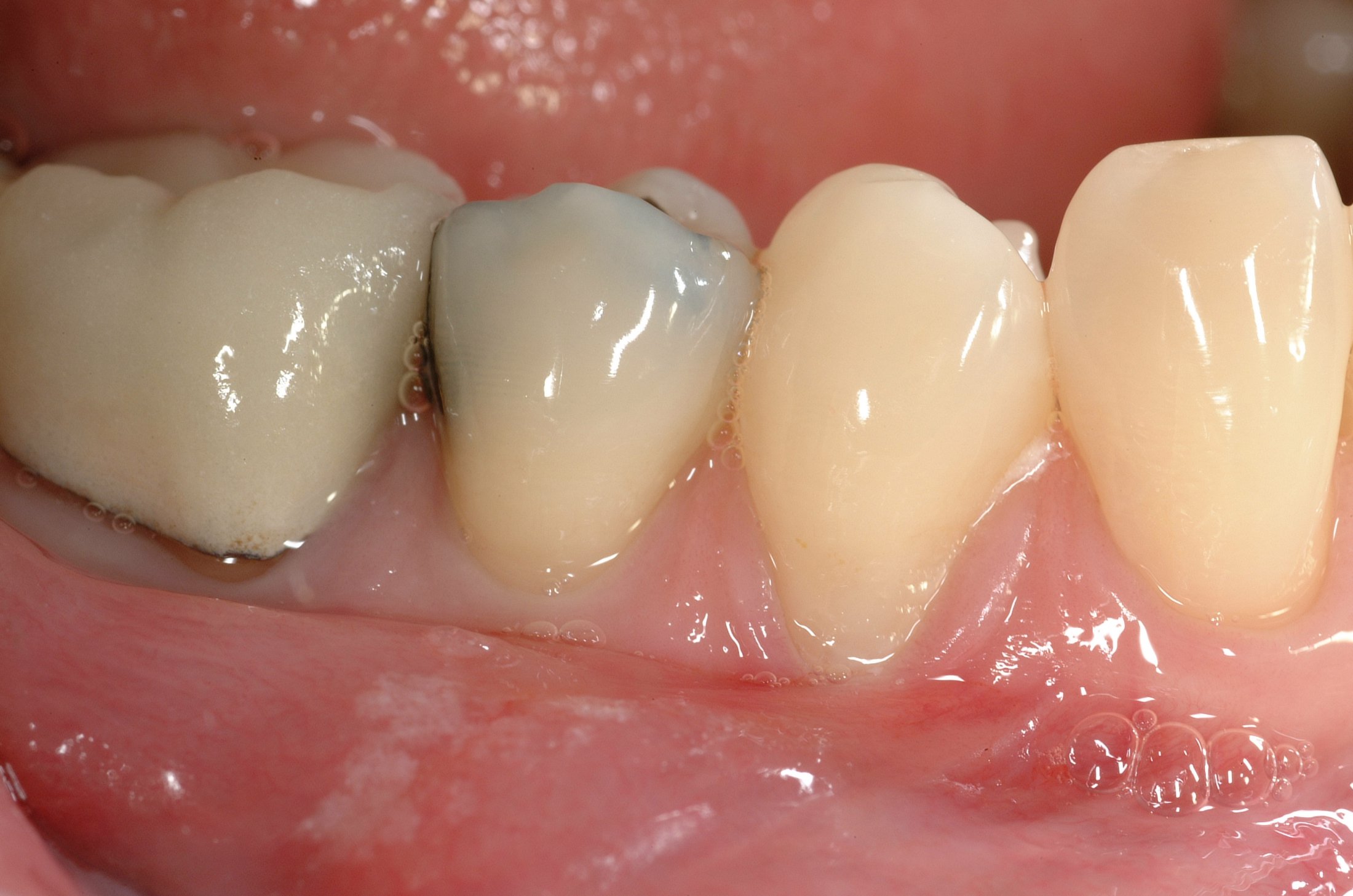 Allograft case study