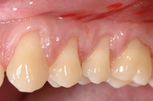 Connective Tissue Graft case study