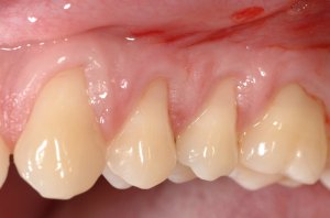 Connective Tissue Graft case study
