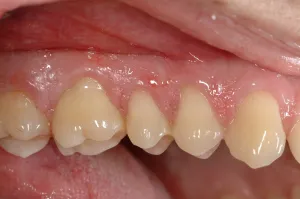 Connective Tissue Graft case study